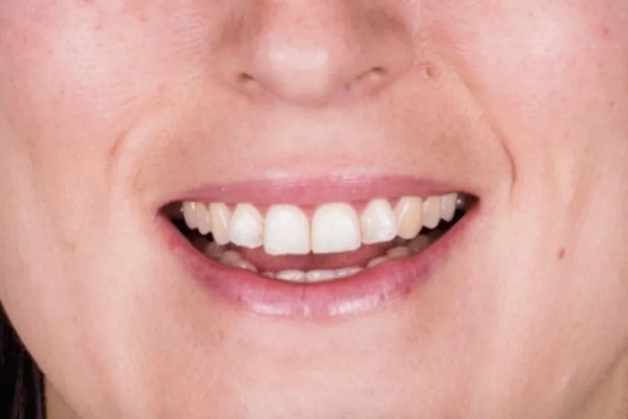 Carillas Dentales Malaga | Lola Escalante Estudio Dental 3