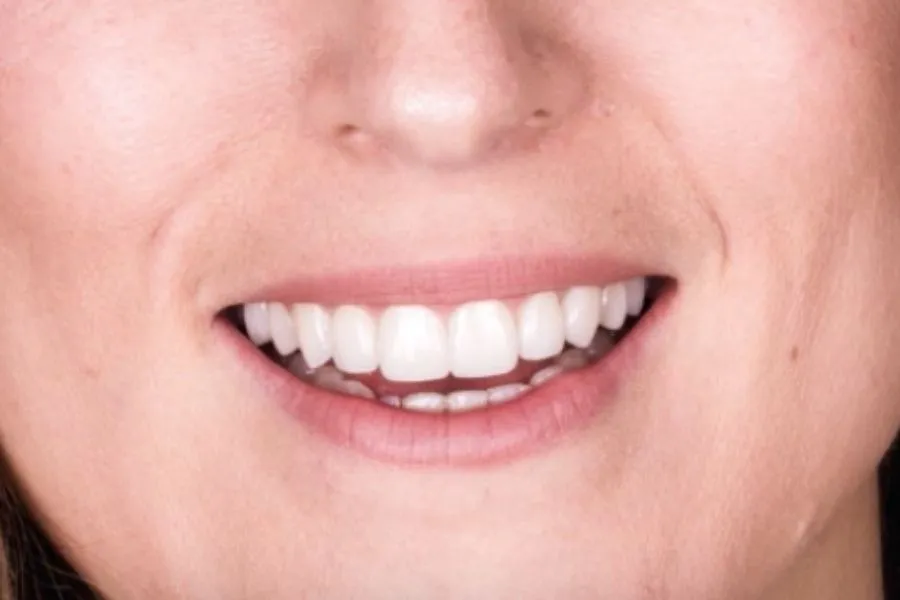 Carillas Dentales Malaga | Lola Escalante Estudio Dental 4