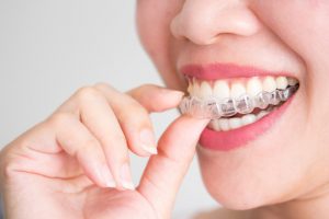 Ortodoncia para Adultos ¿Cuál es el límite de edad para llevarla? | Lola Escalante Estudio Dental 2